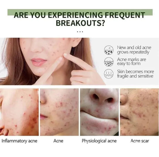 Uptown La Anti-Acne Face Serum